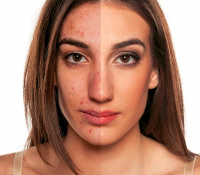 Women showing before and after treatment of acne scar