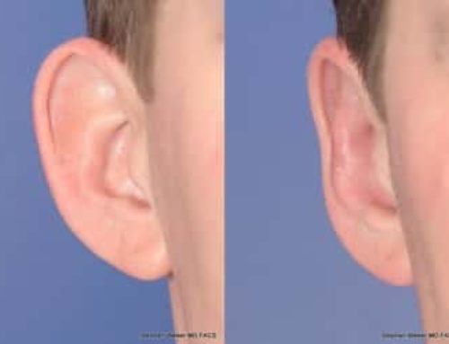 Easy Earlobe Reduction Techniques