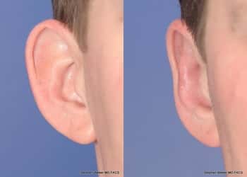 Earlobe Reduction Techniques